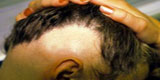 Alopecia areata โรคผมร่วงเป็นวงเดียว วงใหญ่