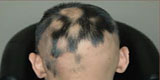 Alopecia areata ผมร่วงเป็นวงๆ หลายวงมารวมกันเกือบเป็นวงใหญ่