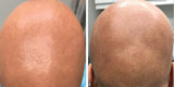 Alopecia Totalis ที่ผมร่วงทั้งศีรษะ