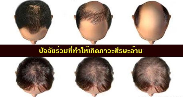 สาเหตุของผมร่วงศีรษะล้านในผู้ชายและปัจจัยที่เกี่ยวข้อง