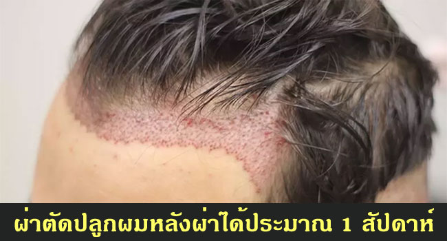 ผ่าตัดปลูกผมแบบมีแผลหลังผ่าได้ 1 สัปดาห์ (FUSS - Follicular Unit Strip Surgery)