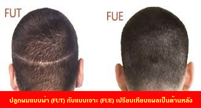 เปรียบเทียบแผลเป็นด้านหลังของการปลูกผมแบบมีแผล (FUT) กับแบบเจาะ (FUE)