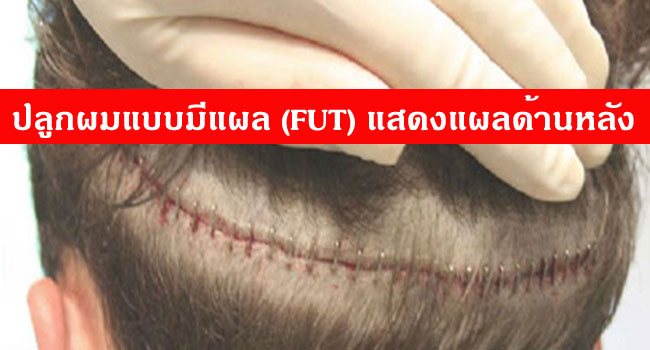 ปลูกผมแบบ FUT แสดงแผลเป็นด้านหลังที่ผ่าเอารากผมออกมา