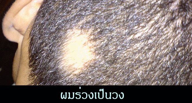 ผมร่วงเป็นหย่อม - Alopecia Areata